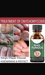 Nail Fungus